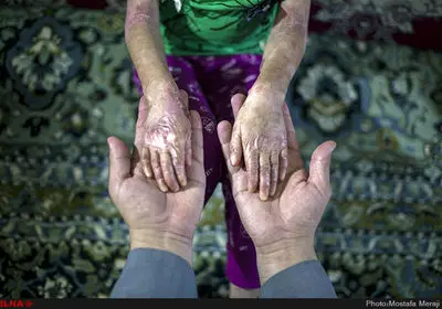 رنج بیماران پروانه‌ای جنوب کشور در شرایط قطعی برق