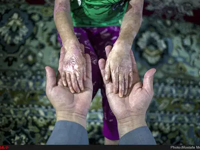 رنج بیماران پروانه‌ای جنوب کشور در شرایط قطعی برق