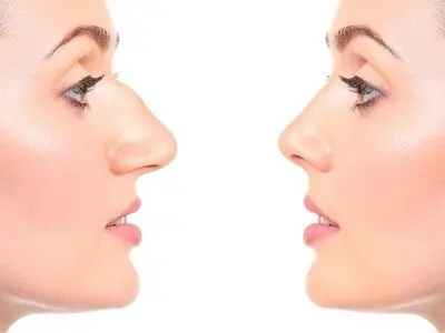 نکات مهم در مورد قبل و بعد از عمل بینی