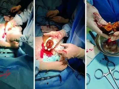 ماجرای وحشتناک «خرمالو» در اتاق‌های عمل!