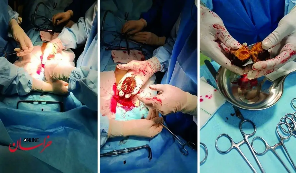 ماجرای وحشتناک «خرمالو» در اتاق‌های عمل!