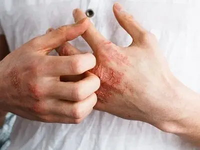 علل، علایم و درمان اگزمای آلرژیک 