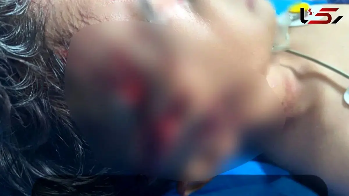 حمله وحشتناک سگ ولگرد به کودک ۹ ساله در مریوان