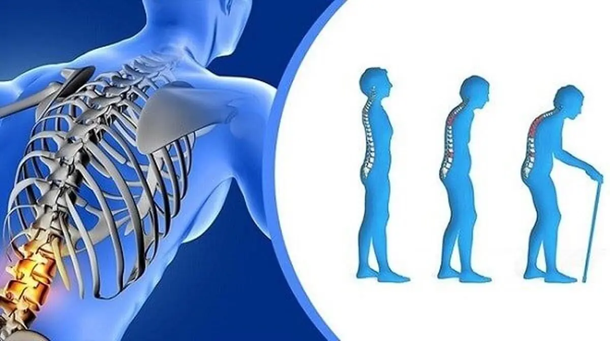 ادغام برنامه ملی کنترل پوکی استخوان در نظام مراقبت‌های اولیه سلامت