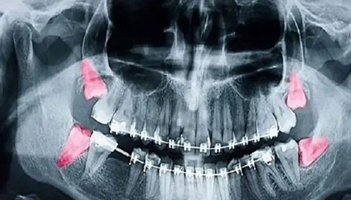 رادیوگرافی دندانی در دوران بارداری بی‌خطر است