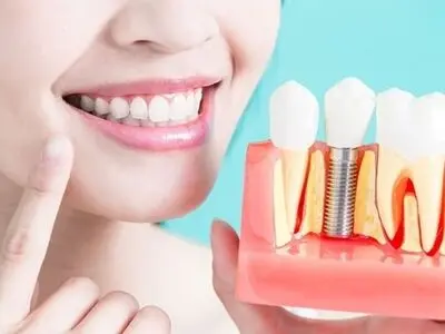 ایمپلنت دندان چه محاسنی نسبت به بریج دندان دارد؟