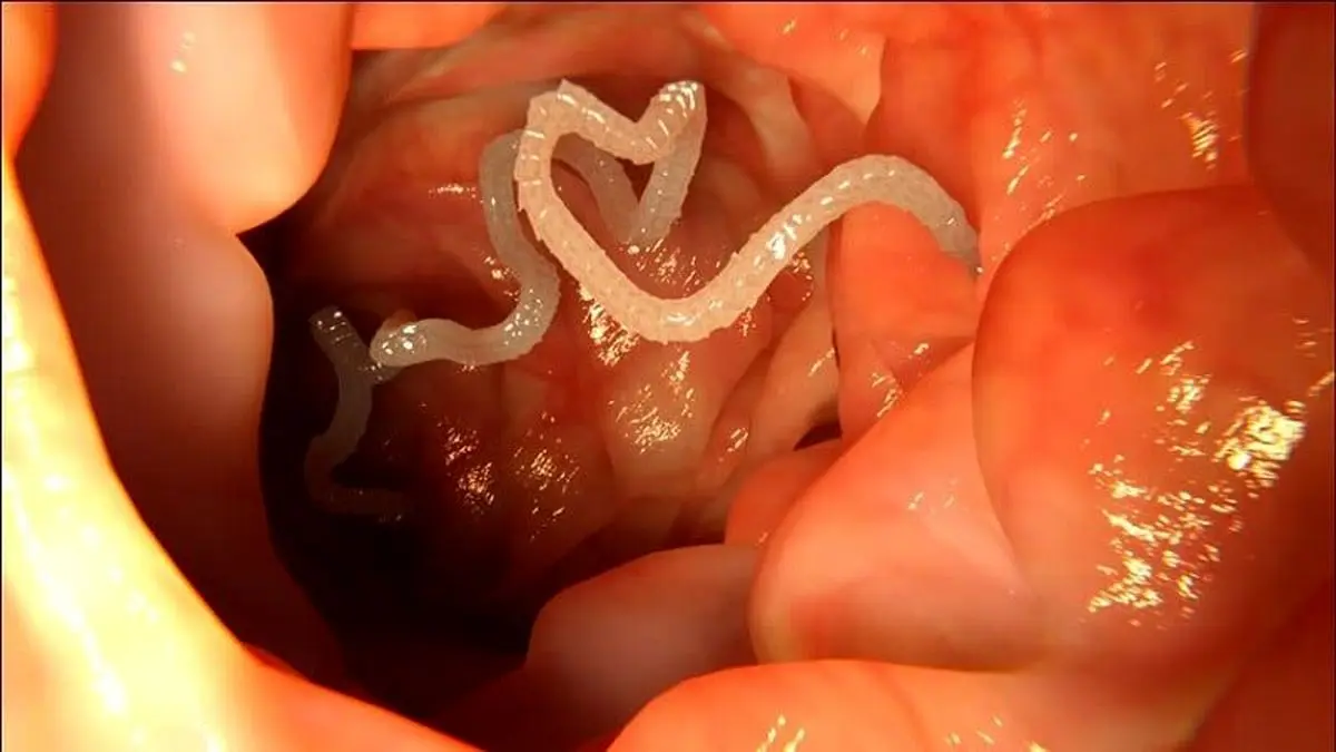 ۱۲ علامت که خبر از وجود انگل‌ها در بدن‌تان می‌دهد! چه کار کنیم؟