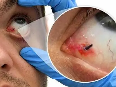 در زمان تروما یا ضربه به چشم در اثر انفجار چه باید کرد؟