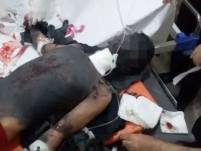 قطع 2 دست نوجوان روانسری بر اثر انفجار "مواد محترقه