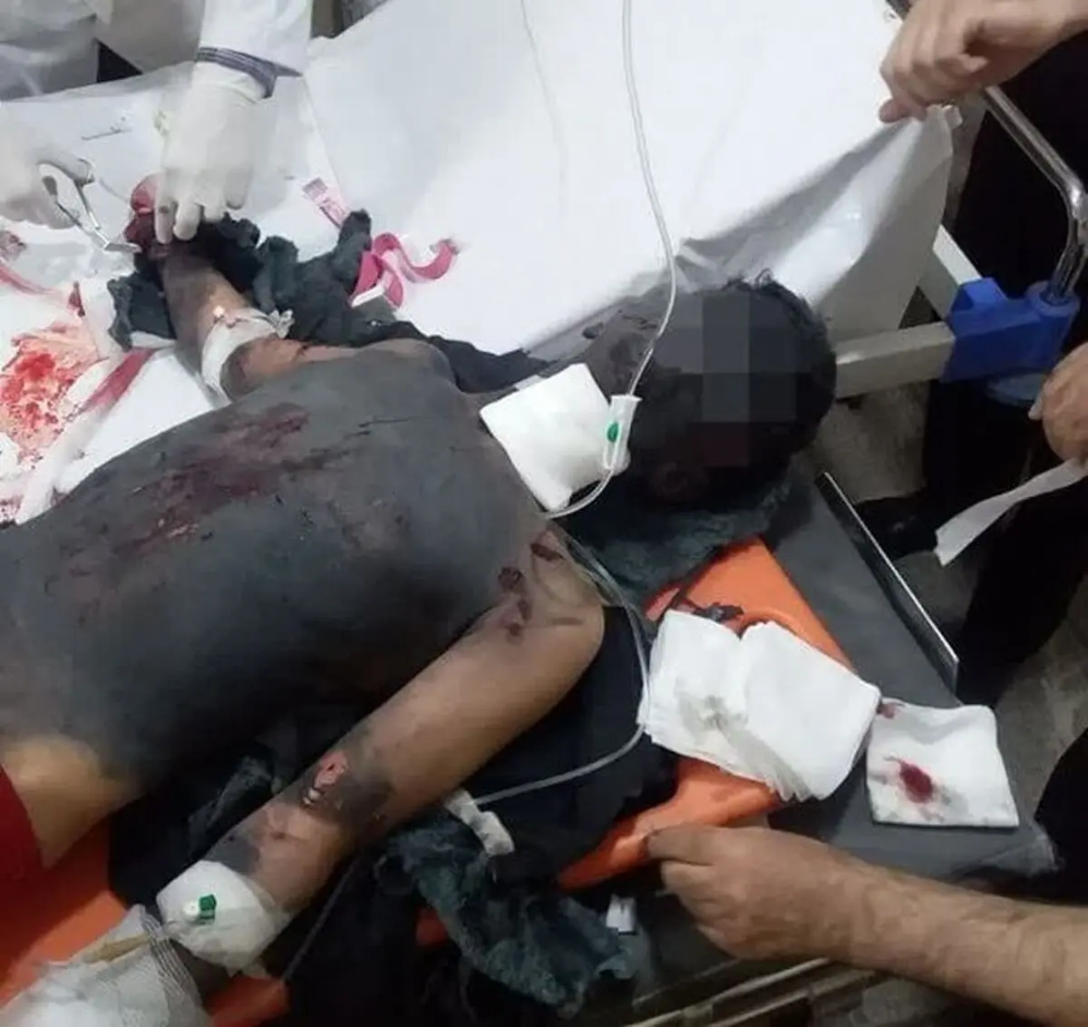 قطع 2 دست نوجوان روانسری بر اثر انفجار "مواد محترقه