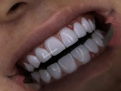 ایمپلنت دندان با ضمانت را در کجا انجام دهیم؟