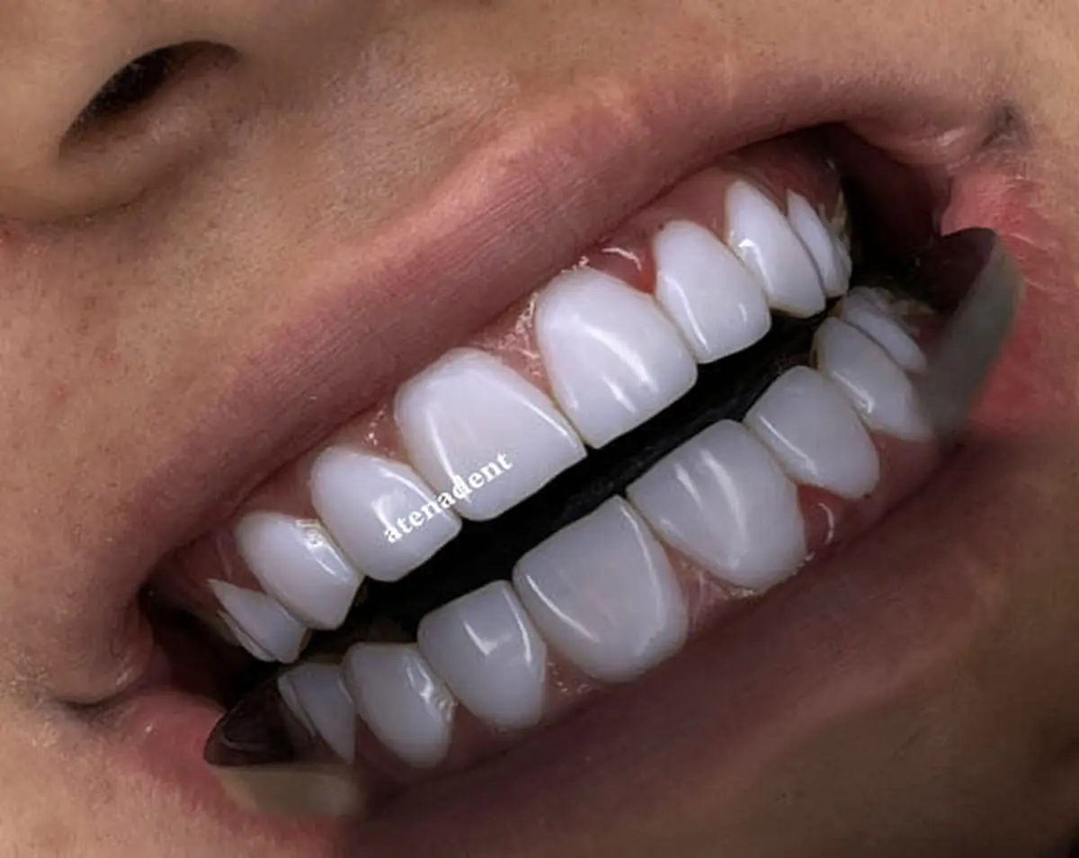 ایمپلنت دندان با ضمانت را در کجا انجام دهیم؟