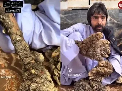 بیماری پوستی که یک مرد بلوچ را شبیه درخت کرد + فیلم