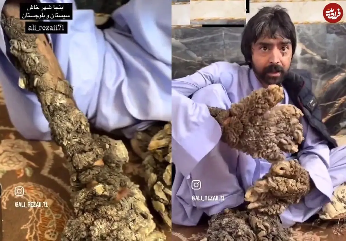 بیماری پوستی که یک مرد بلوچ را شبیه درخت کرد + فیلم