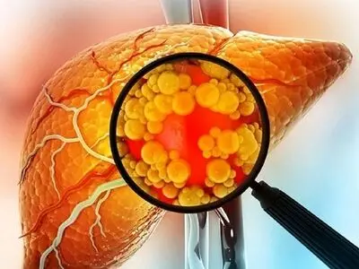 راهکارهای طلایی برای جلوگیری از کبد چرب + اینفوگرافیک