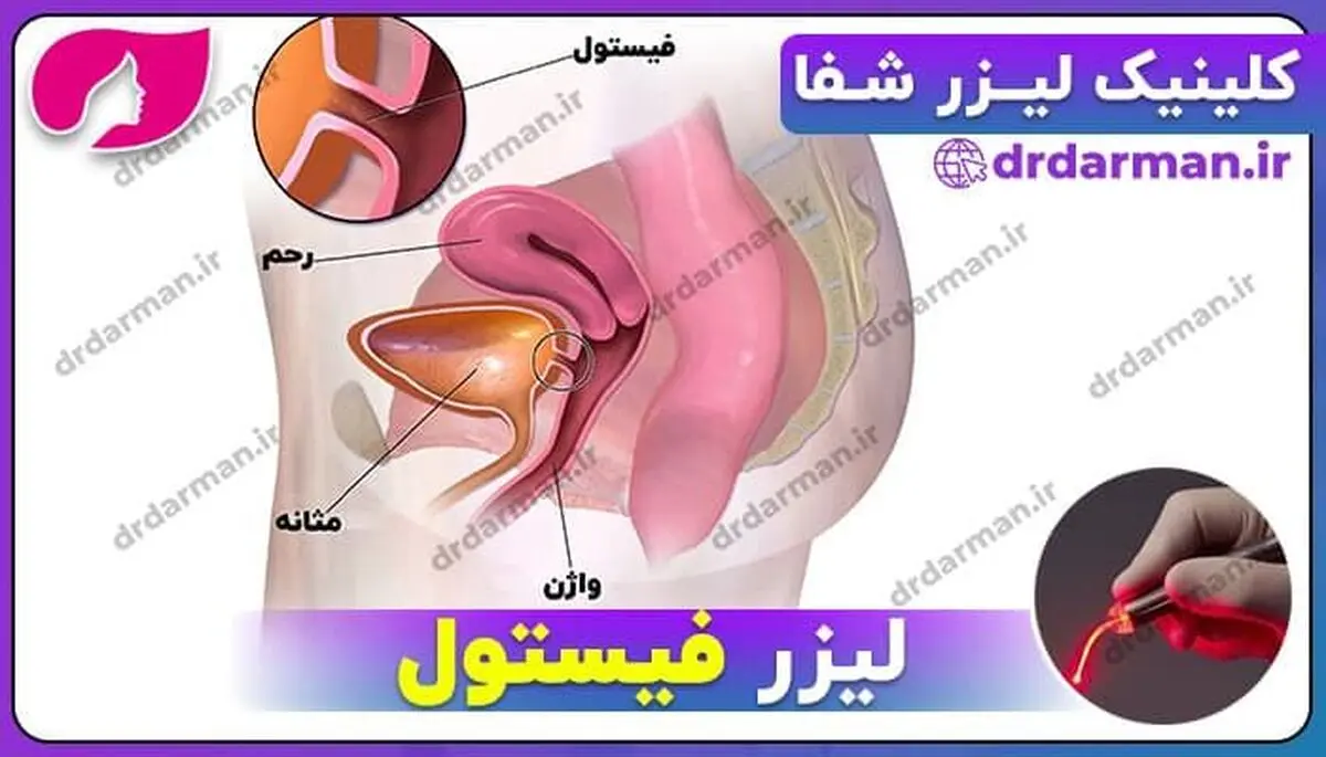 لیزر فیستول