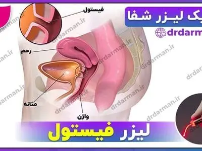 لیزر فیستول