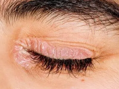 دلیل اصلی خشکی پوست دور چشم و راه حل آن