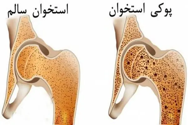 پوکی استخوان با تشخیص زود هنگام قابل درمان است