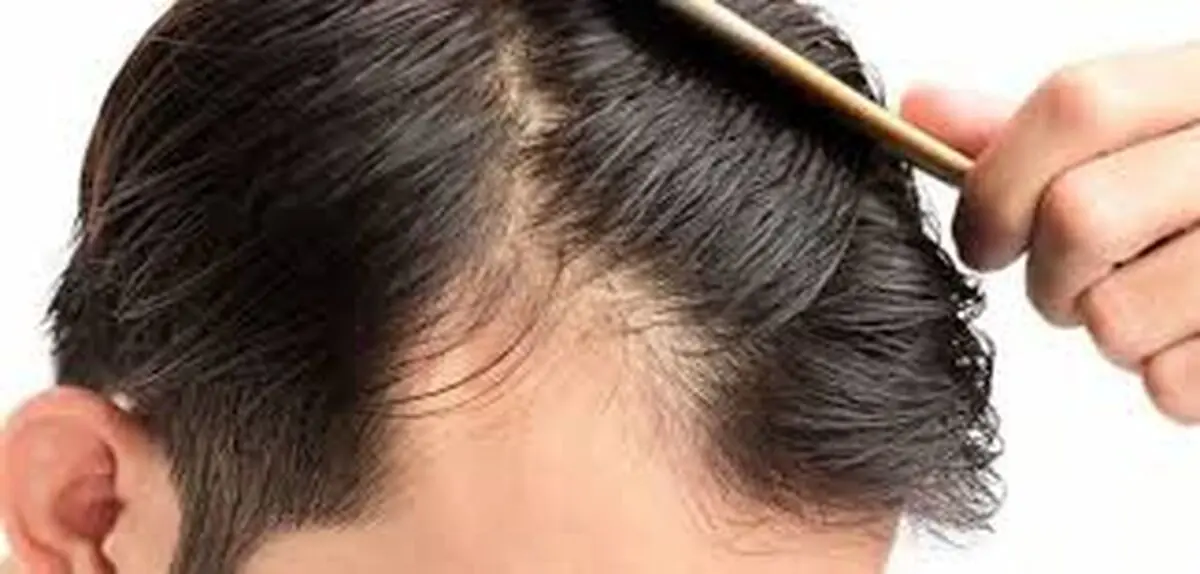 اشتباهاتی که موجب ریزش مو می‌شوند 
