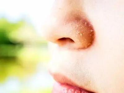 علل خشکی پوست بینی و پوسته پوسته شدن دور آن