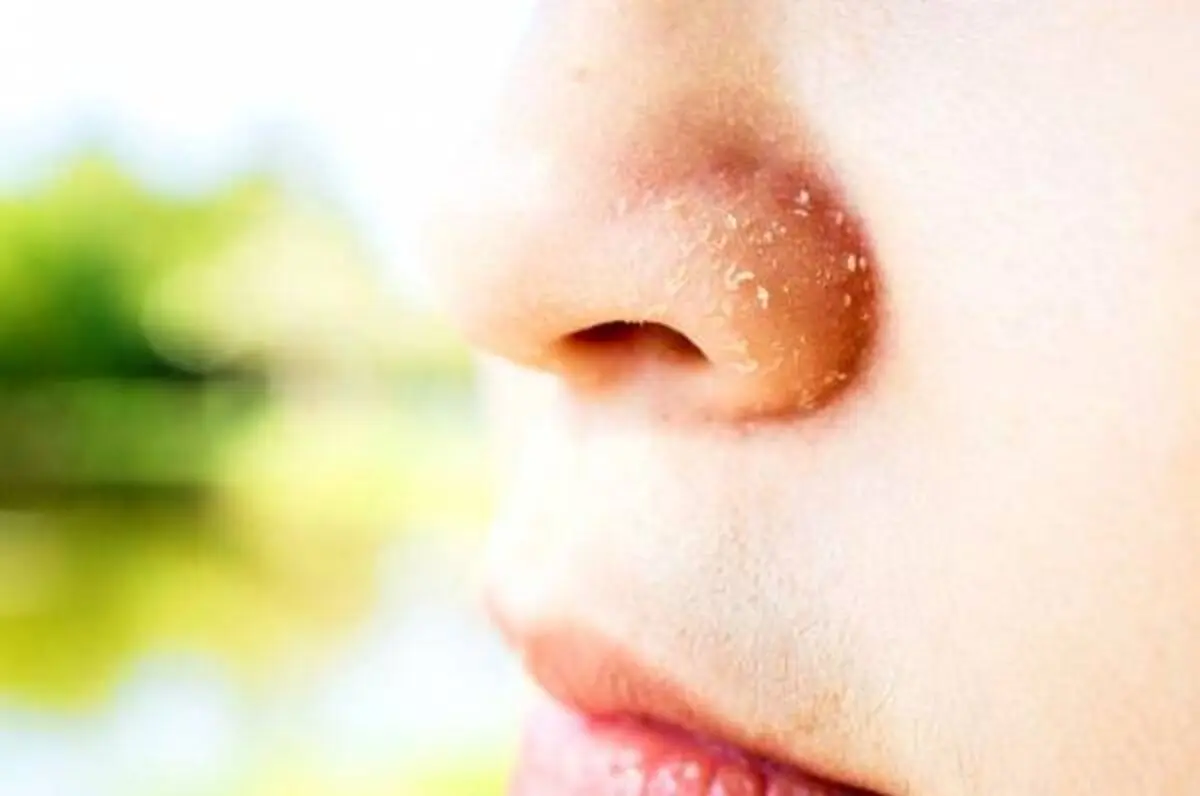 علل خشکی پوست بینی و پوسته پوسته شدن دور آن