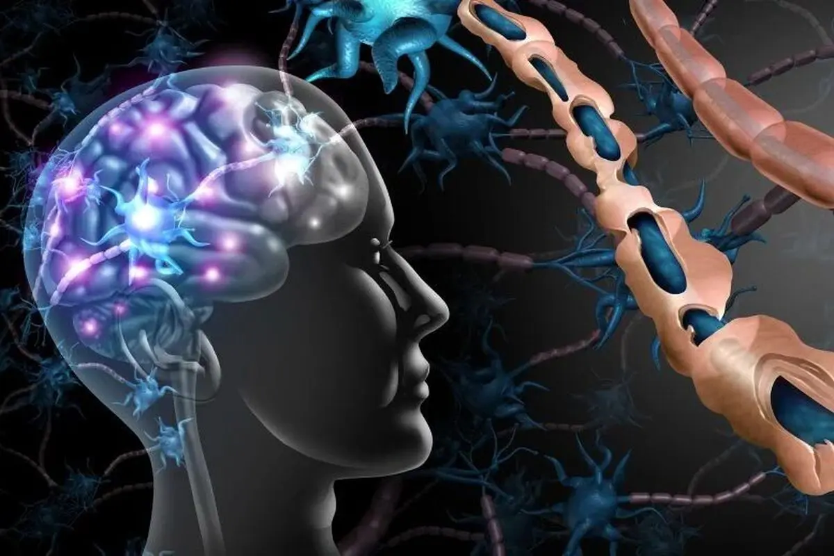 اِم‌اِس ممکن است بیش از یک دهه پیش از بروز علائم آغاز شود