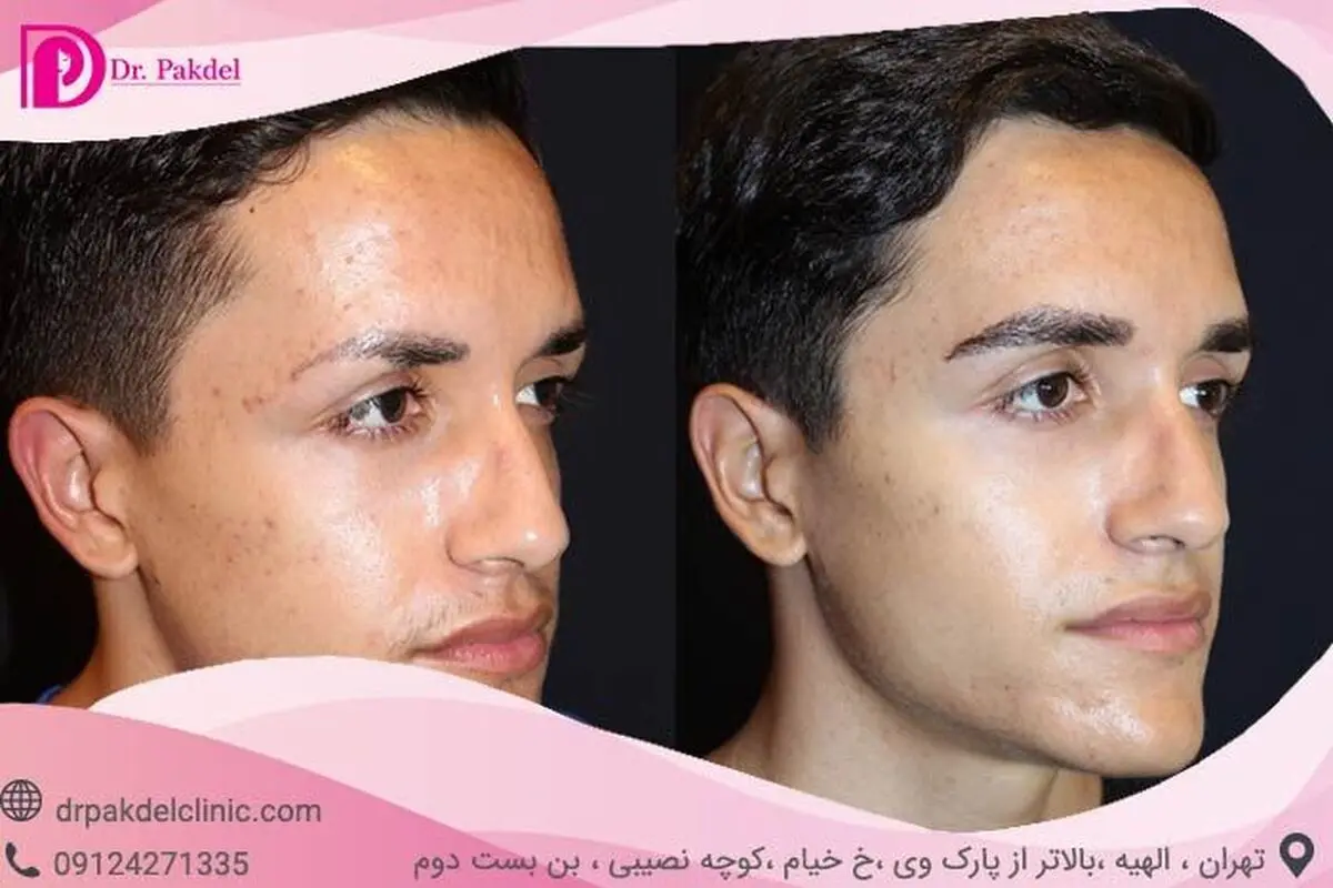 کاشت ابرو طبیعی چیست و چگونه انجام می‌شود؟