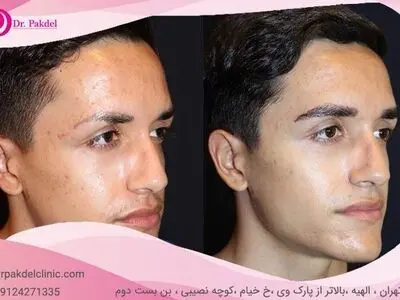 کاشت ابرو طبیعی چیست و چگونه انجام می‌شود؟