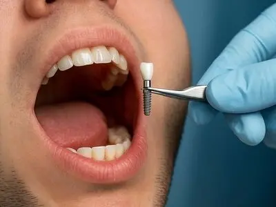 راهنمای جامع قیمت ایمپلنت دندان + نکات ضروری قبل از درمان