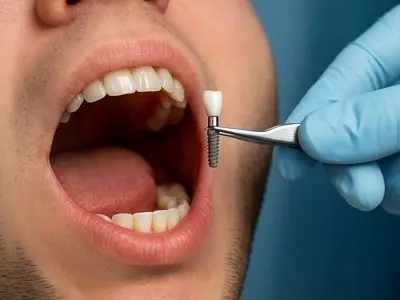 راهنمای جامع قیمت ایمپلنت دندان + نکات ضروری قبل از درمان