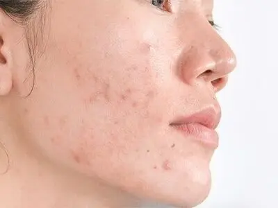 چگونه از شر لکه های سیاه روی پوست خلاص شویم