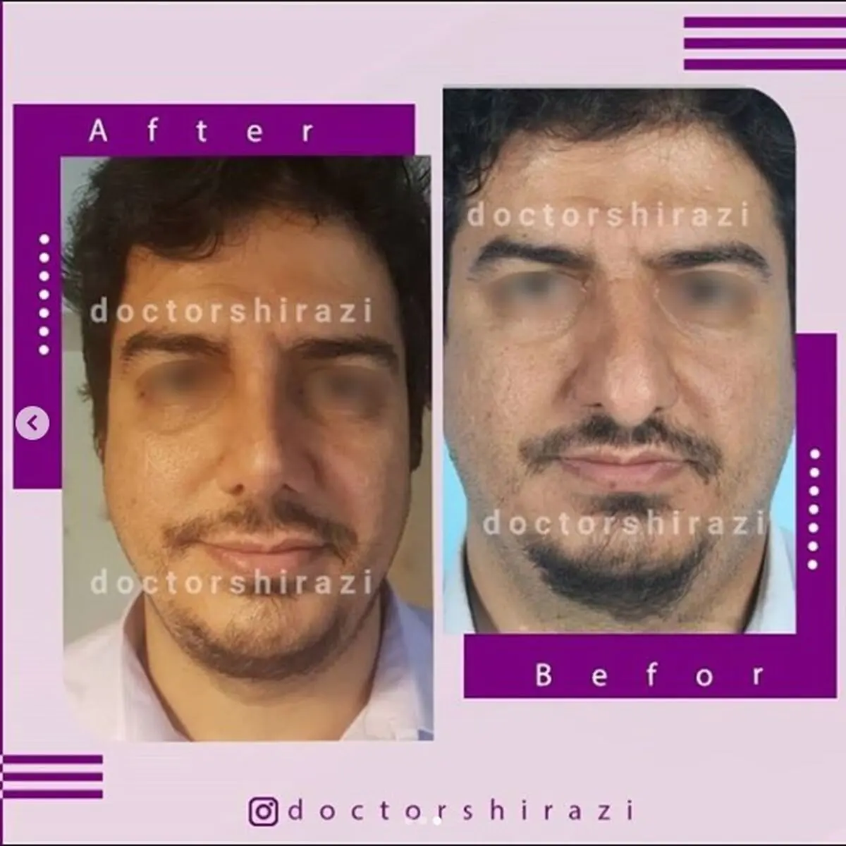 عمل بینی، یک جراحی حساس و شگفت انگیز