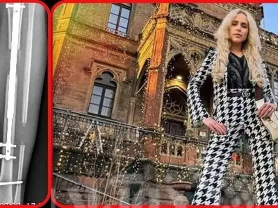 دختر جوان با خرج ۷۵۰ میلیون تومان، ۱۴ سانتی‌متر قدش را افزایش داد!
