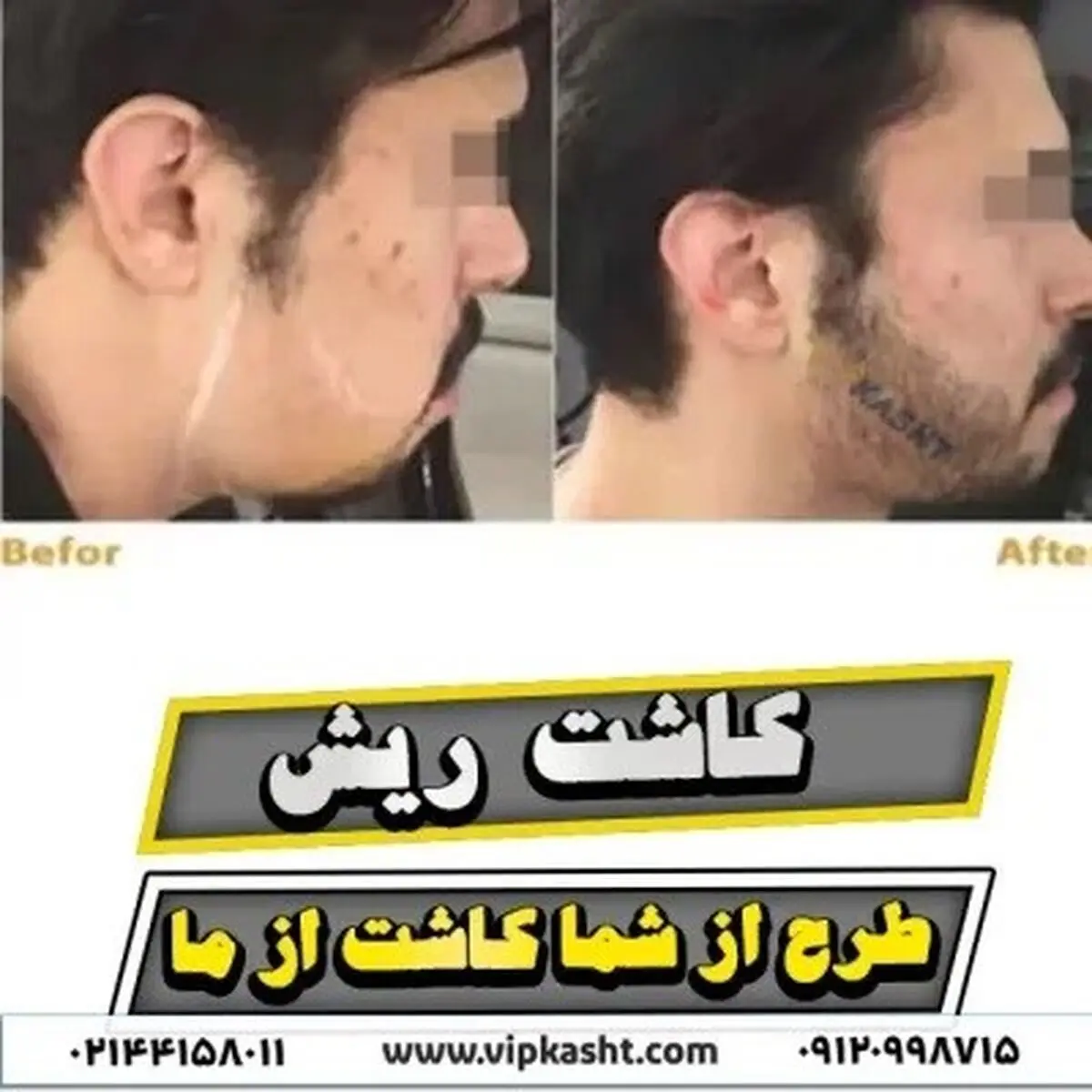 آیا اصلاح بعد از کاشت ریش امکان پذیر است؟