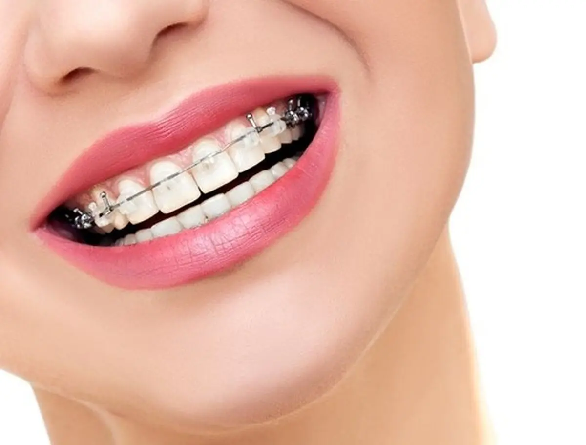 ارتودنسی متحرک چیست و برای چه کسانی مناسب است؟