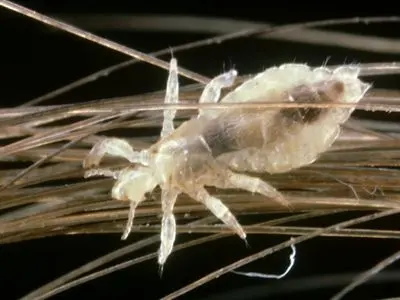 درمان خانگی شپش موی سر 