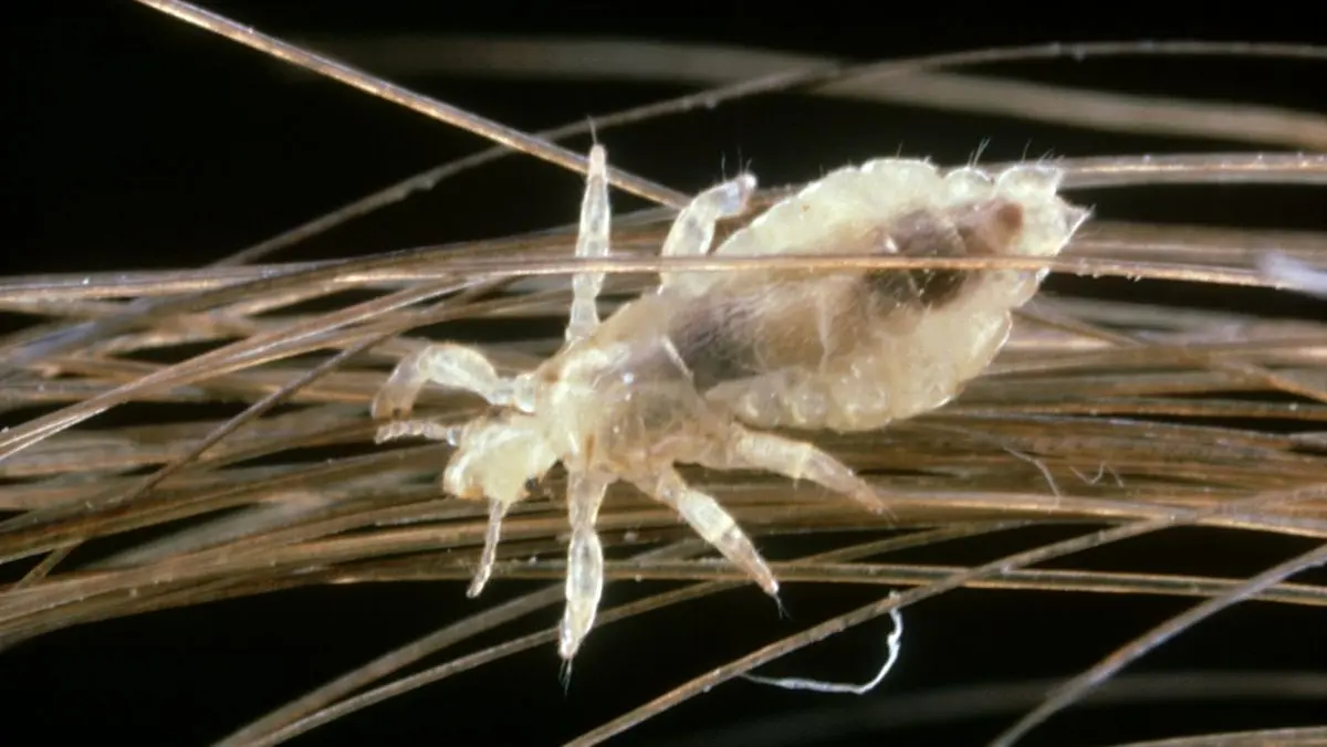 درمان خانگی شپش موی سر 