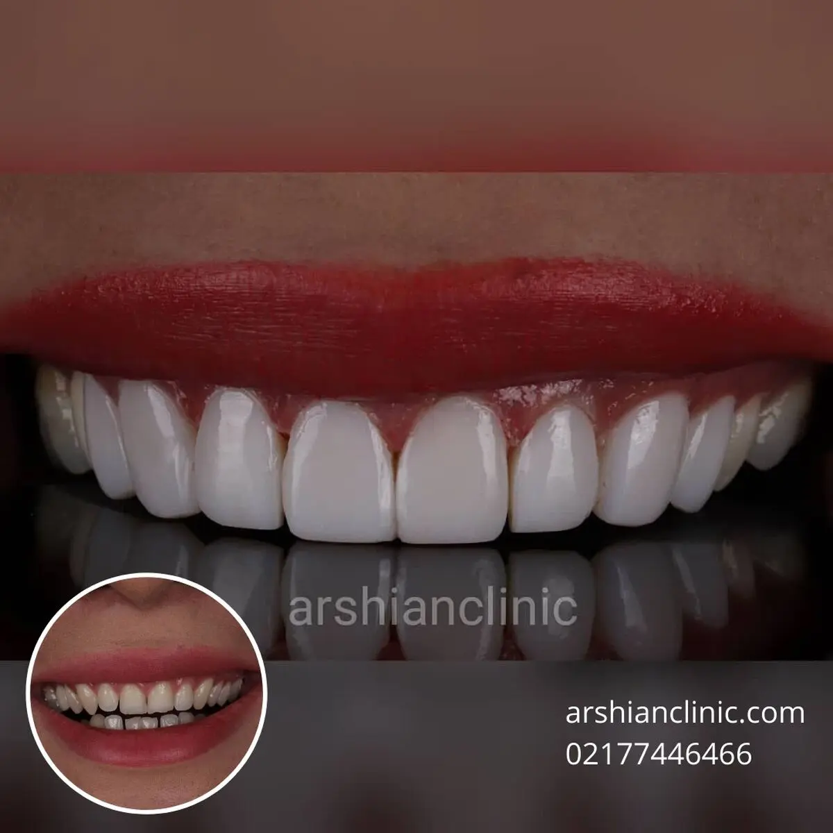مثلث سیاه بین دندان ها، برمودای باکتری ها!