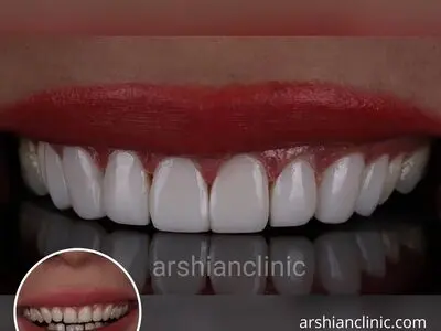 مثلث سیاه بین دندان ها، برمودای باکتری ها!
