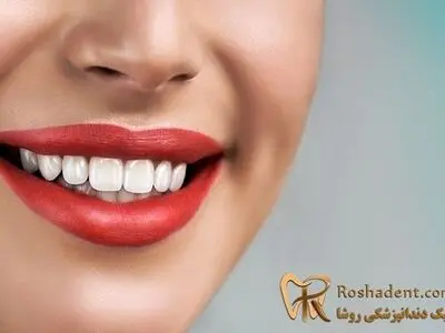 ایمپلنت دندان چیست ؟ (هزینه ایمپلنت دندان 1400) تخفیف ویژه