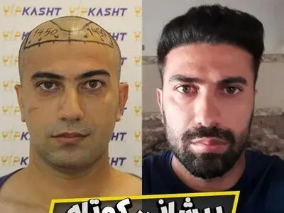هزینه کاشت مو در سال 1401