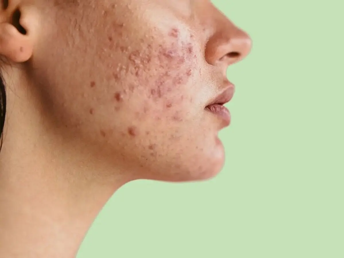 معجزه نوره برای رفع جوش‌های صورت؛ چطور مصرف کنیم؟