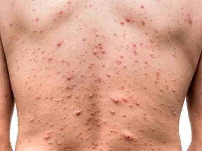 ابتلا به آبله مرغان برای چه کسانی خطرناک‌تر است؟
