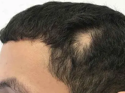 همه چیز درباره علت و درمان ریزش سکه ای مو