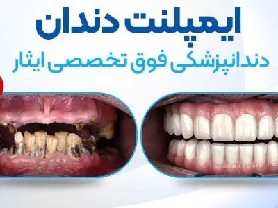 ایمپلنت اقساطی؛ کاشت ایمپلنت به صورت قسطی چگونه است؟     