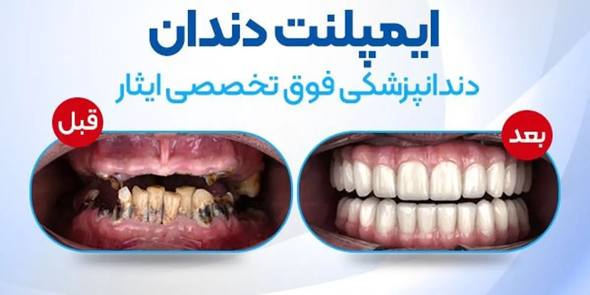 ایمپلنت اقساطی؛ کاشت ایمپلنت به صورت قسطی چگونه است؟     