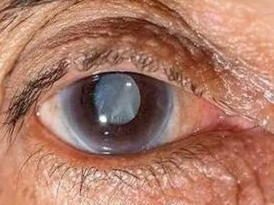 کردستان دارای بیشترین موارد ابتلا به بیماری آب‌سیاه  در کشور/ مبتلایان به آب سیاه کراوات نزنند