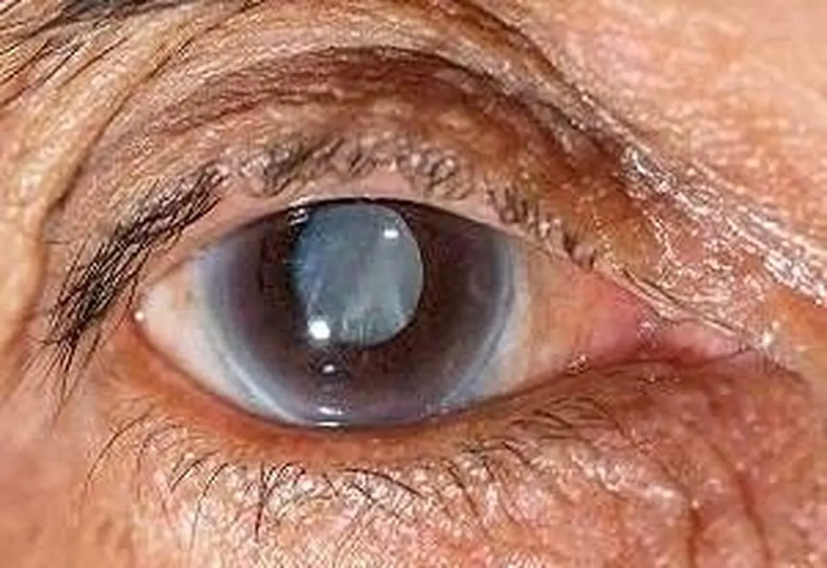 کردستان دارای بیشترین موارد ابتلا به بیماری آب‌سیاه  در کشور/ مبتلایان به آب سیاه کراوات نزنند