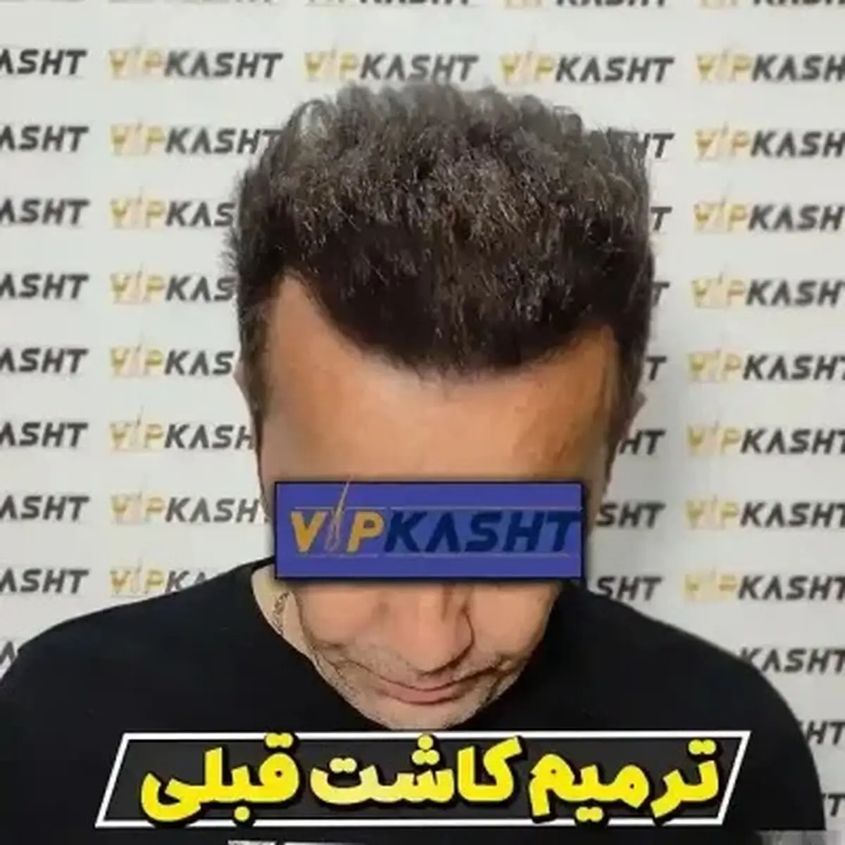 آشنایی با روش کاشت مو  (BHT)